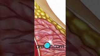 PreOp® Breast Health What Happens During a Needle Biopsy 🌸 preop shorts health 🏥 [upl. by Ahker901]