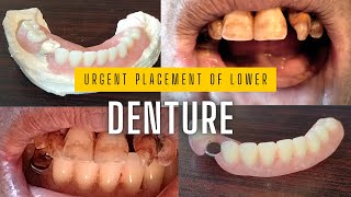 Removable lower partial denture urgent fitting  partial denture dentures missingtooth asmr [upl. by Marella]