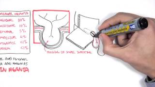 Introduction to Direct and Indirect Inguinal Hernia [upl. by Lednek]