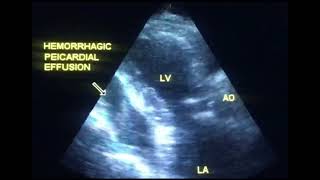 Pericardial effusion or hemopericardium to drahmadmirdamadisi4YcoVxIYKdkLrw2q [upl. by Lady]