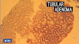 Tubular Adenoma [upl. by Yaresed476]