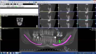 Implant PLanning with Acteon Imaging Suite CBCT Cone Beam part 2 [upl. by Okim637]