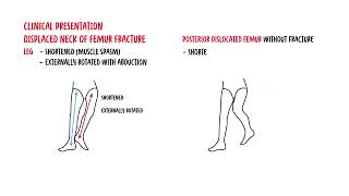 Understanding Neck of Femur Fractures [upl. by Ynnavoig]