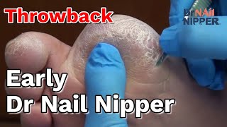 Throwback  Nail Contusion Trimming Painful Corns on Toes callus on diabetic amputee [upl. by Arvind]