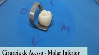 Molar Inferior  Cirurgia de Acesso [upl. by Orpha]