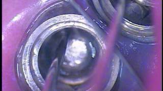 Broken Dental Implant Abutment Screw Retrieval  22 [upl. by Bronwyn]