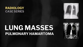 Pulmonary hamartoma  Radiology  truefisp [upl. by Airamas]