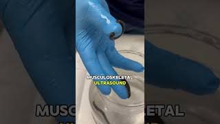 Leech Therapy for Shoulder Pain [upl. by Aprile370]