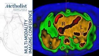 Cardiomyopathies II Restrictive and Inflammatory M AlMallah MD D Shah MD February 1 2022 [upl. by Ettennod229]