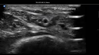 arterial cannulation ultrasound guided out of plane radial artery [upl. by Suckram416]