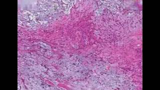 Histopathology Salivary glandPleomorphic adenoma mixed tu [upl. by Perla128]