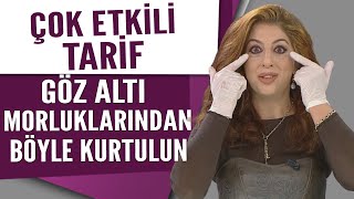 Cilt lekelerine karşı çok etkili tarif Göz altı morluklarından böyle kurtulun [upl. by Nojram]