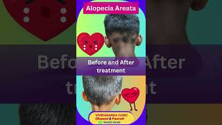 Alopecia Areata before and after treatment homeopathy [upl. by Ebneter]