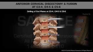 Anterior Cervical Discectomy amp Fusion at C34 C45 amp C56 [upl. by Eirollam246]