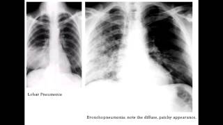 Lobar Pneumonia amp Bronchopneumonia  Organisms amp Characteristics [upl. by Quartus]