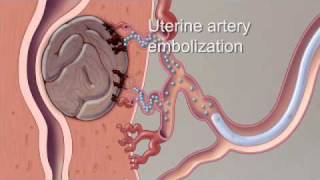 Fibroid Treatment Options  Mayo Clinic [upl. by Rendrag]