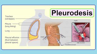 pleurodesis [upl. by Tereb]