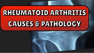 Rheumatoid arthritis lecture1Rheumatoid arthritis causes amppathology [upl. by Akienat]