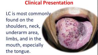 10 MIN REVISION Lymphangioma Circumscriptum [upl. by Christopher]