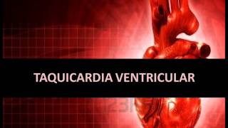 Arritmias cardíacas  Taquicardia ventricular [upl. by Nerraf]