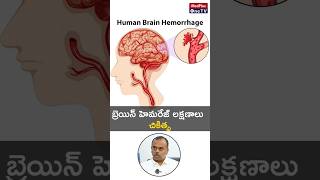 What is a Brain Hemorrhage and Treatments You Need to Know l Dr S Ramesh shorts MedPlusONETV [upl. by Yaluz]