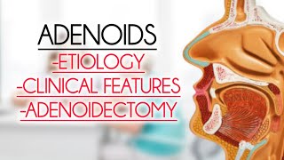 ADENOIDS ETIOLOGY CLINICAL FEATURESADENOIDECTOMY [upl. by Aihseyt543]