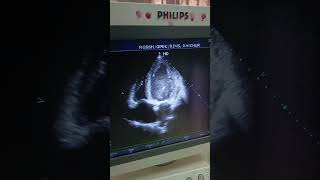 2D ECHO  EF 38  LV GLOBAL HYPOKINESIA DILATED LV LA RA [upl. by Yasmin]