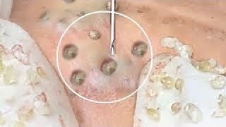 Pimple Popping 2020 Video 41 Blackheads removal Acne removal acne treatment [upl. by Cyd]