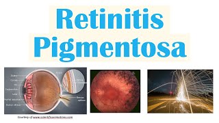 Retinitis Pigmentosa  Genetics Pathophysiology Signs amp Symptoms Diagnosis Treatment [upl. by Nolyd]