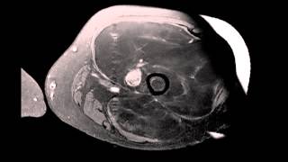 Well differentiated Liposarcoma Left Thigh [upl. by Yarw386]