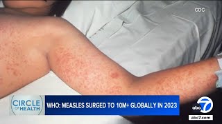 Amid global measles surge heres what LA County is doing right [upl. by Ailime]