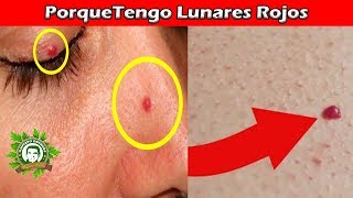 Porque Tengo Lunares Rojos En La Piel a Qué Se Deben y Como Poder Quitarlos Con Este Genial Remedio [upl. by Rotciv331]