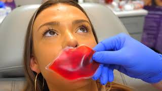 Natural Looking Full Lips  Start to Finish With 1 Syringe of Juvederm [upl. by Ruenhcs]