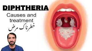 Diphtheria  Symptoms Causes and treatment [upl. by Tsnre261]