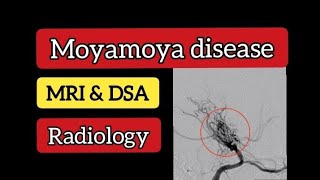 MOYAMOYA Disease  MRI MRA amp DSA  Radiology [upl. by Hammer]