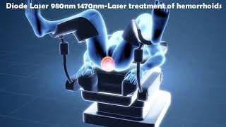 Laser Hemorrhoidoplasty LHP  IBI Healthcare Institute [upl. by Allesig410]