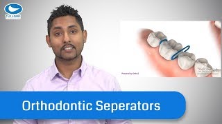 Orthodontic SeparatorsSpacers  What they are and TIPS [upl. by Toh]