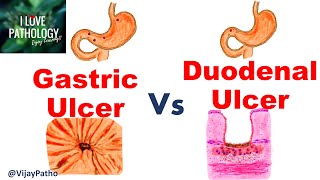 Peptic Ulcer Disease GASTRIC VS DUODENAL ULCERS [upl. by Adamik]