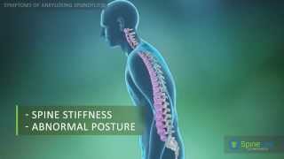 Ankylosing Spondylitis Symptoms [upl. by March]