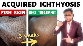 Acquired ichthyosis  Fish skin  Treatment  Hindi [upl. by Laverne]