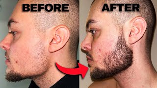 Minoxidil Beard Before And After  2 Months Progress [upl. by Uase]