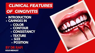 Clinical Features Of Gingivitis  Periodontology Lecture [upl. by Pesek]