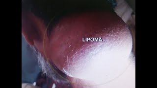 LIPOMA NECK [upl. by Suckram481]