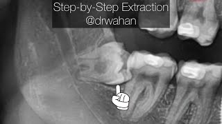 Step by Step Wisdom Tooth Extraction with buccal trough and buccolingual split [upl. by Netsrik]