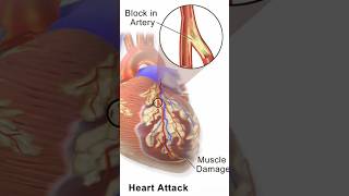 Posterior Lateral Wall MI 2D Echo Findings [upl. by Neema387]