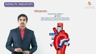 Syphilitic aneurysm  ascending aorta amp arch or aorta   Pathology Usmle step 1 Fmge and Neet Pg [upl. by Deidre]