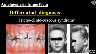 Amelogenesis Imperfecta Dr  Safaa Bassam Shihabi [upl. by Schindler]