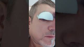 Augenlidstraffung Erfahrungen mit der Augenoberlid OP eyelid surgery [upl. by Brine]