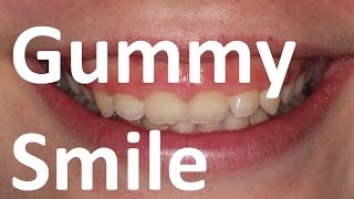 Orthotropics Treatment of Gummy Smile Excessive Gingival Display by Prof John Mew [upl. by Loesceke718]