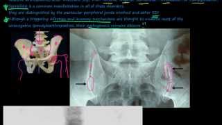 96P Introduction to the Seronegative Spondyloarthropathies [upl. by Anide503]